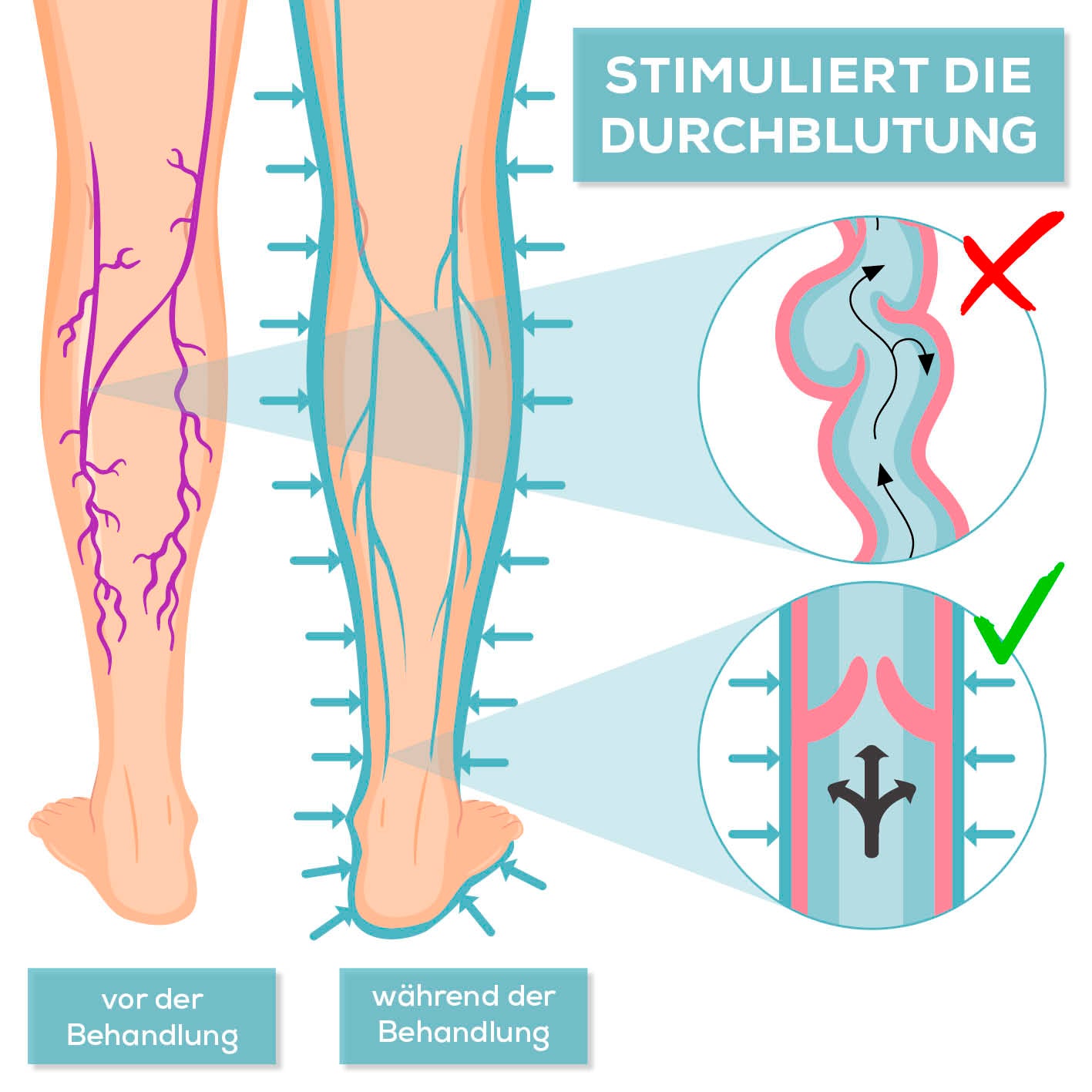 Illustration zur Wirkungsweise des Therapiegeräts VenenWalker Pro2 bei venösen Durchblutungsstörungen vor und während der Behandlung.